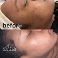 Microneedling​